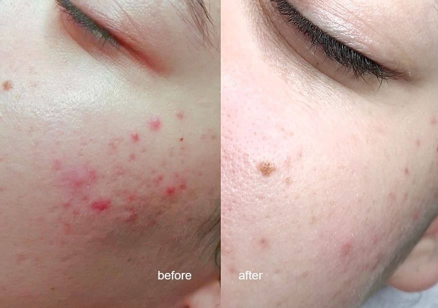 Two face pictures showing many pimples before and much less after the treatment